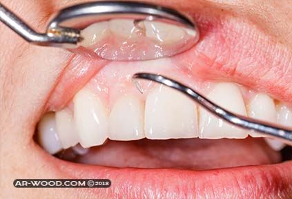 علاج التهاب اللثة بعد تركيب الاسنان