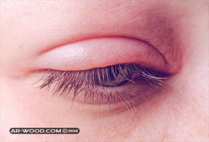 علاج التهاب جفن العين العلوي بالاعشاب 