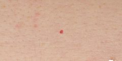 أسباب ظهور حبوب دموية على الجلد